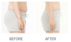 Soraya-laser-hair-removal-Cavitation-cellulite-Anti-again-weightloss-regimen-acne-dermalift-purelight-body-treatment-dermapod- beauty-salon-spa-injectiontreatmen-non-surgical-rejuvenate-skin-facial